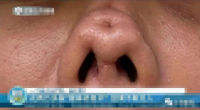 Chi hơn 80 triệu đồng để phẫu thuật thẩm mỹ, nữ streamer cay đắng nhận lại chiếc mũi với 4 lỗ