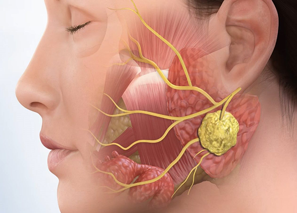 Ung thư vòm họng là loại ung thư đầu mặt cổ phổ biến