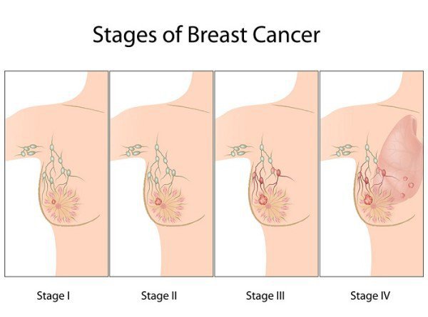 ung thư vú có liên quan đến những đột biến gen