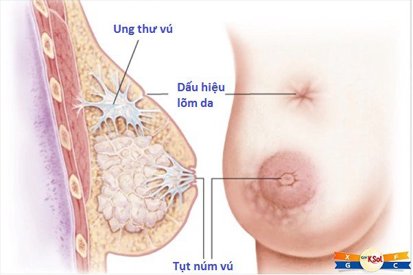 Ung thư vú: Nguyên nhân, triệu chứng, chẩn đoán và điều trị