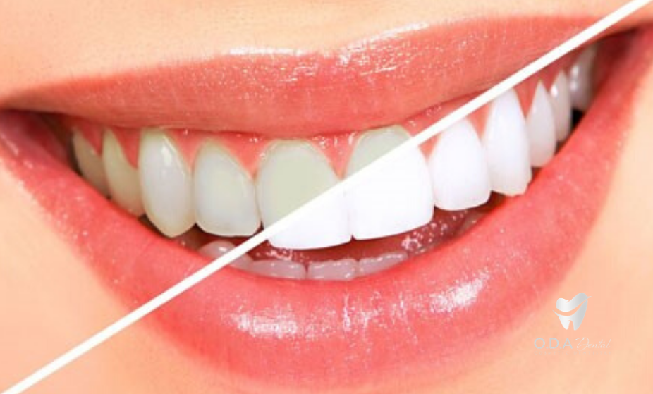 [Tẩy trắng răng] TOP 10 thực phẩm giúp răng bạn trắng sáng tự nhiên