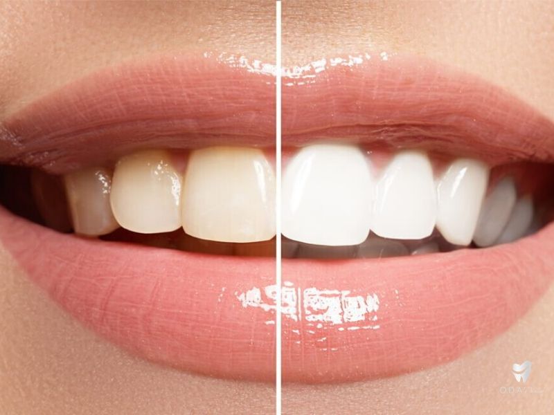 [Nha khoa TP HCM] Các phương pháp tẩy trắng răng hiện nay
