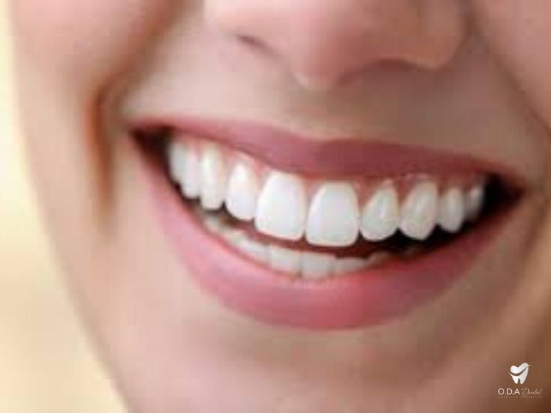 [Nha khoa uy tín hcm] Khi nào nên trám răng và trám ở đâu mới tốt?