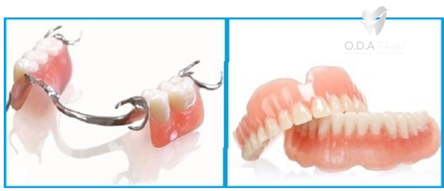 Làm răng giả tháo lắp có bị tiêu xương hàm không?