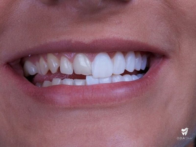 Nha khoa làm sứ | Những lí do khiến bạn nên trồng răng sứ toàn sứ