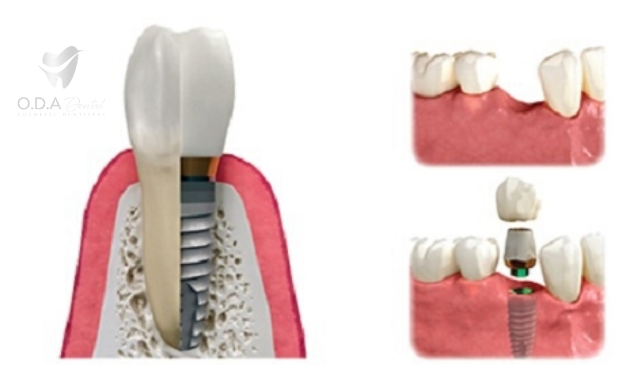 Làm răng giả tháo lắp có bị tiêu xương hàm không?