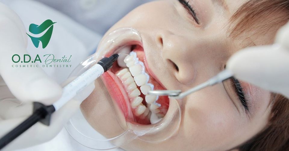 Quy Trình Chuẩn Nhất Cho Phương Pháp Tẩy Trắng Răng Tại Nhà