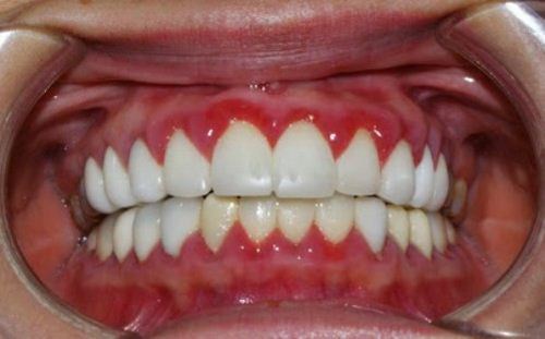 [Kiến thức nha khoa quận 10] Trồng răng sứ và bị đau thì nên làm gì?