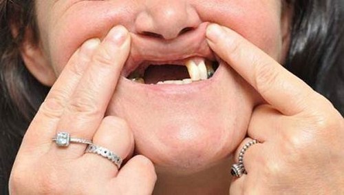 Tổng hợp các cách làm răng giả phổ biến dành cho người già