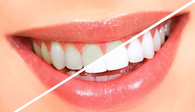 Làm thế nào để tẩy trắng răng hiệu quả khi đang niềng răng?