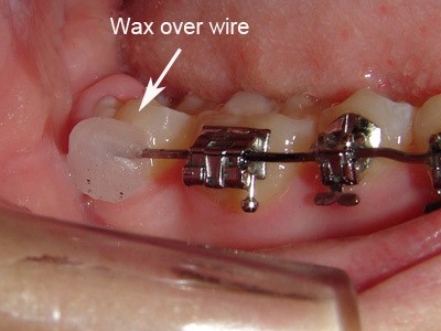 Tại sao niềng răng lại bị chảy máu nướu? Nguyên nhân do đâu
