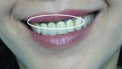 Nha khoa răng sứ | Có nên trồng răng sứ kim loại cho răng cửa không?