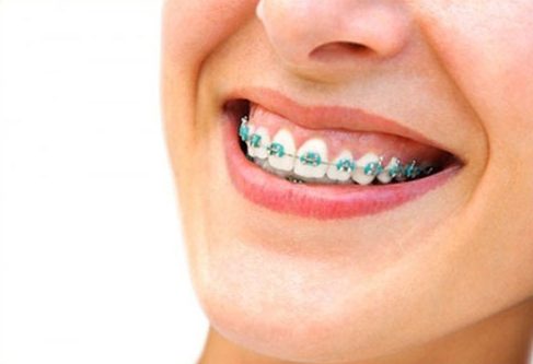 Tại sao niềng răng lại bị hở lợi? Cách khắc phục hở lợi ra sao?