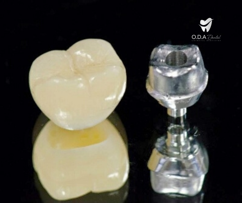 Tổng quan về phương pháp trồng răng sứ | Giá làm răng sứ implant