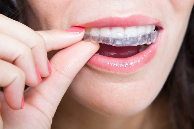 Tất tần tật về phương pháp niềng răng trong suốt invisalign
