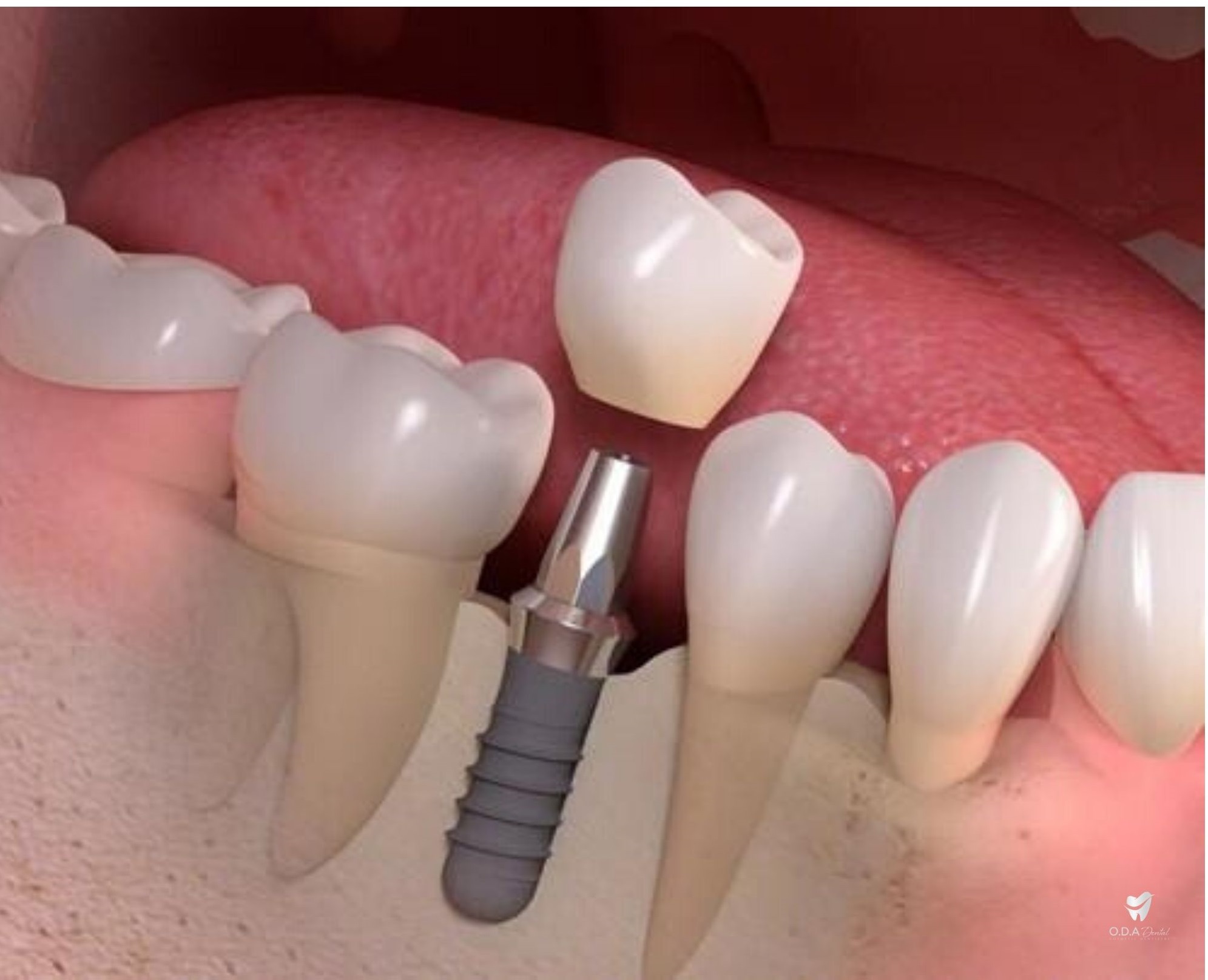 Lưu ý khi trồng implant và bảng giá làm răng implant