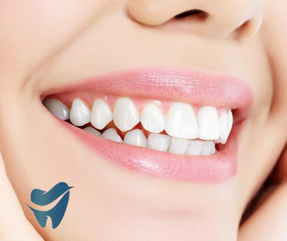 Nha khoa răng sứ | Có nên trồng răng sứ kim loại cho răng cửa không?