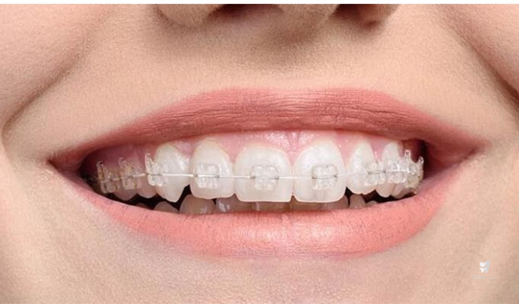 Chia sẻ cách chăm sóc răng miệng trong thời gian niềng răng