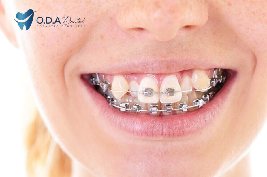Niềng răng khấp khểnh hiệu quả với nha khoa ODA