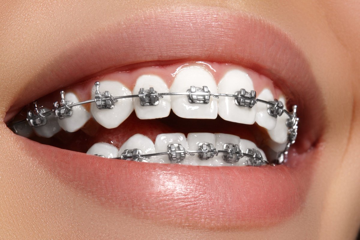 Niềng răng mắc cài tự đóng có những ưu điểm nào?