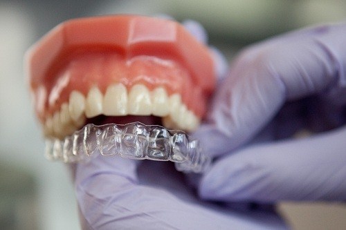 Niềng răng tháo lắp có hiệu quả không ? Chi phí là bao nhiêu ?