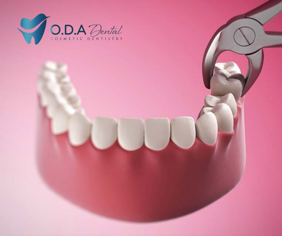 Tại sao khi niềng răng cần phải nhổ răng khôn? | Nha khoa ODA