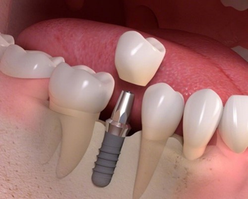 Các phương pháp làm răng cho người cao tuổi giúp cải thiện hàm nhai