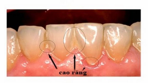 Liệu cạo vôi răng có giúp răng trắng sáng hơn không?