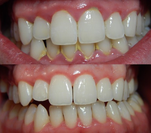 Liệu cạo vôi răng có giúp răng trắng sáng hơn không?