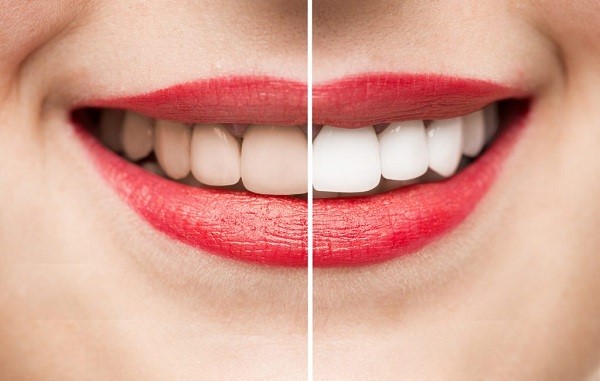 Liệu tẩy trắng răng có hại gì đến sức khỏe răng miệng không?