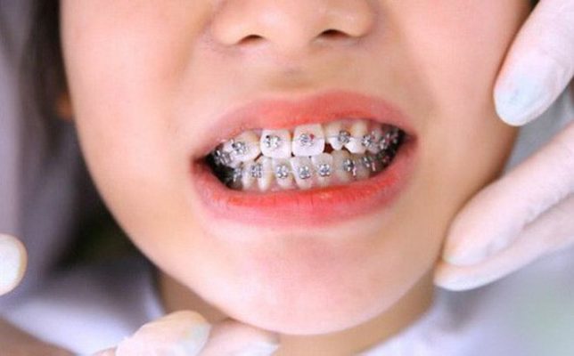 Niềng răng bị hóp má liệu có đúng? Cách khắc phục hiệu quả