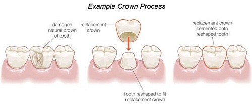 [Nha khoa răng sứ] Tất tần tật về phương pháp trồng răng sứ thẩm mỹ