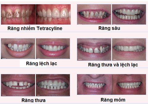 [Nha khoa răng sứ] Tất tần tật về phương pháp trồng răng sứ thẩm mỹ