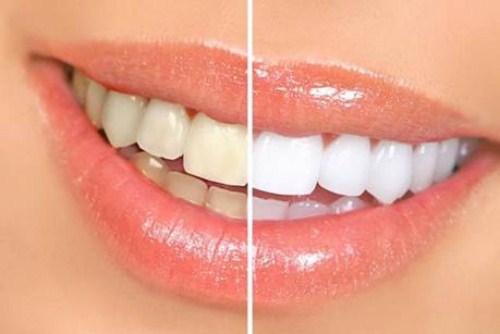 [Tẩy trắng răng nha khoa] Bị ê buốt sau khi tẩy thì làm sao?