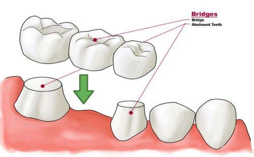 Tổng quan về phương pháp trồng răng sứ | Giá làm răng sứ implant