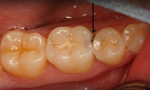 [Nha khoa uy tín hcm] Khi nào nên trám răng và trám ở đâu mới tốt?