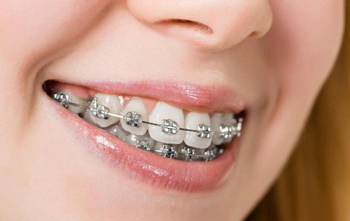 Vệ sinh và chăm sóc răng miệng đúng cách khi niềng răng