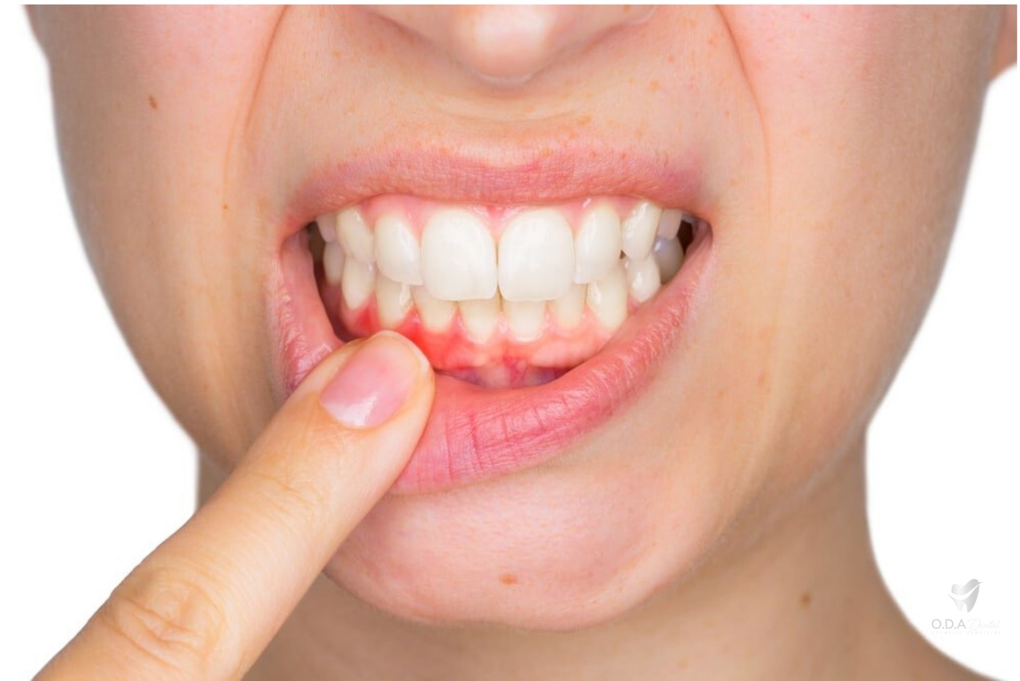 Nha khoa răng sứ | Những biến chứng có thể gặp khi bọc răng sứ