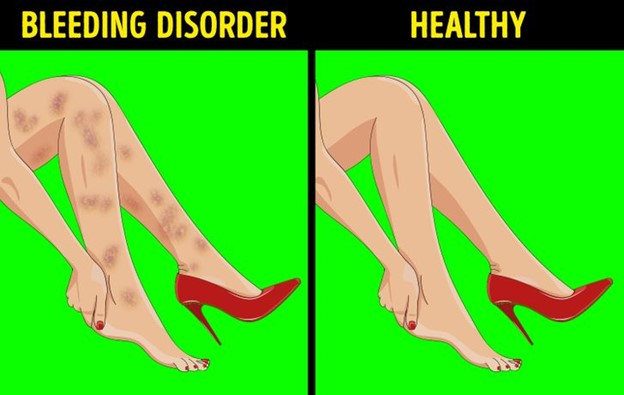 Top 6 Dấu hiệu ở chân có thể cảnh báo về tình hình sức khỏe của bạn